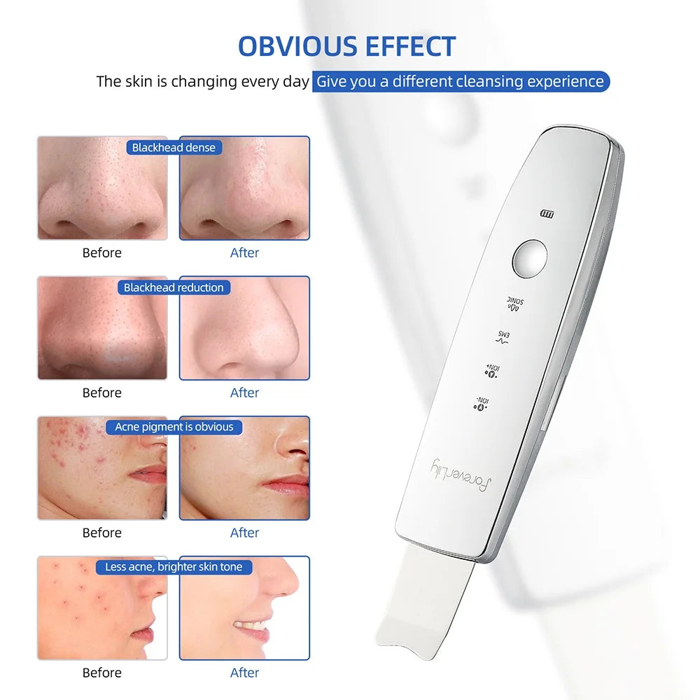 6-in-1 Ultrasonic EMS Skin Scrubber | Deep Cleansing, Blackhead Remover & LED Therapy