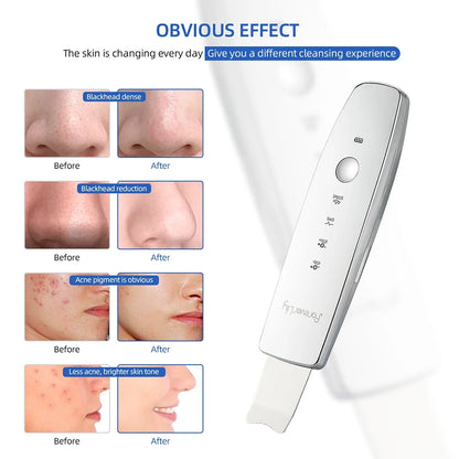 6-in-1 Ultrasonic EMS Skin Scrubber | Deep Cleansing, Blackhead Remover & LED Therapy